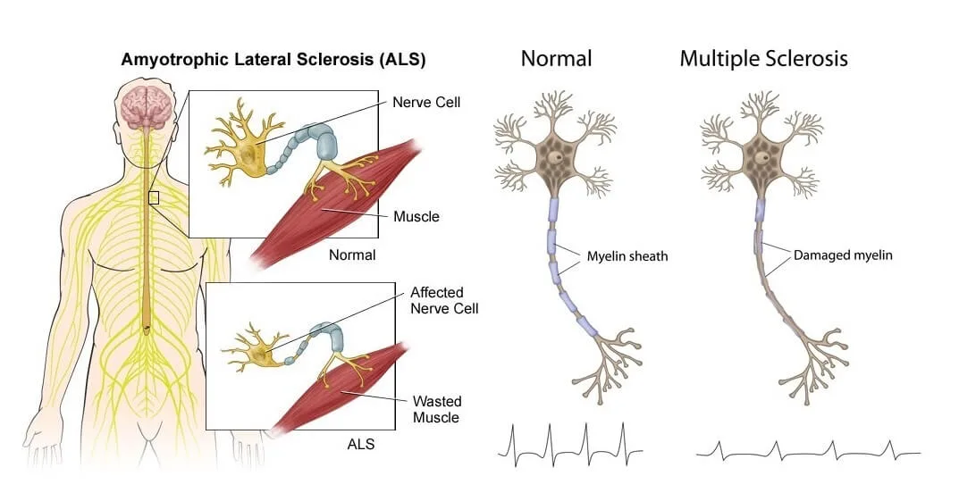 علاج الخلايا الجذعية للتصلب الجانبي الضموري (ALS)
