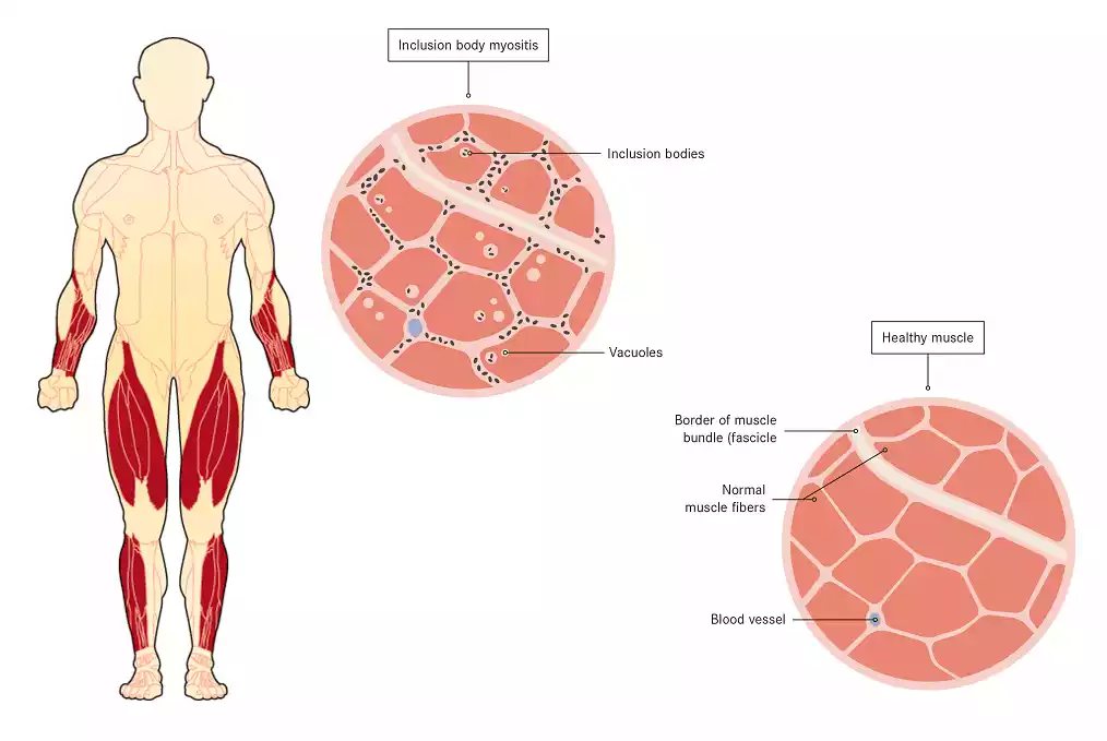 العلاج بالخلايا الجذعية لإدماج التهاب عضلات الجسم