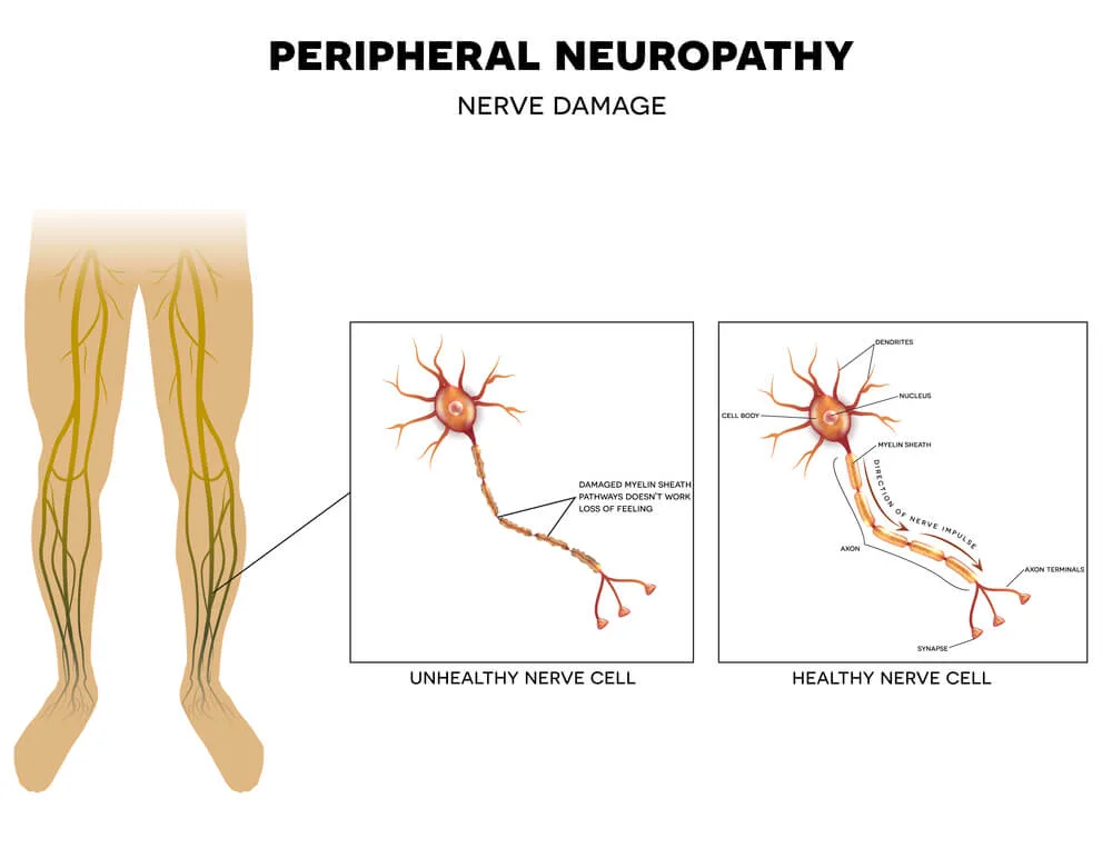 Stem Cell Therapy for Neuropathy