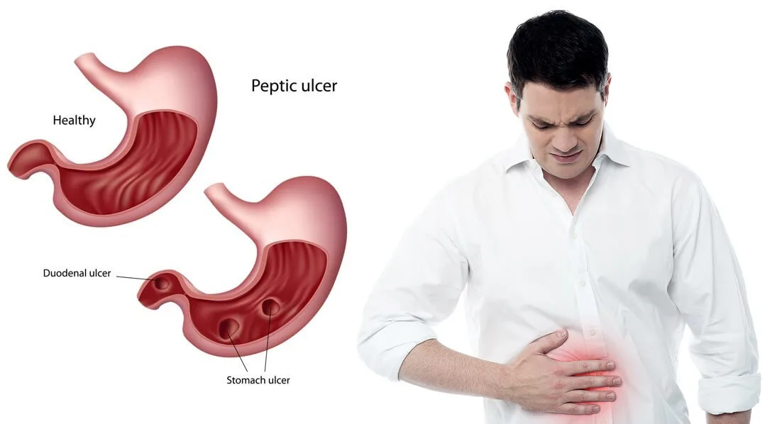 Stem Cell Therapy for Peptic Ulcer