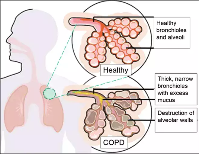 علاج مرض الرئة بالخلايا الجذعية (COPD)