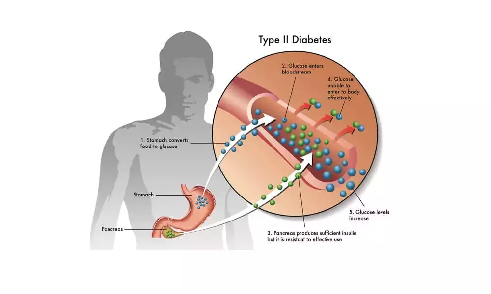 علاج الخلايا الجذعية لمرض السكري من النوع 2