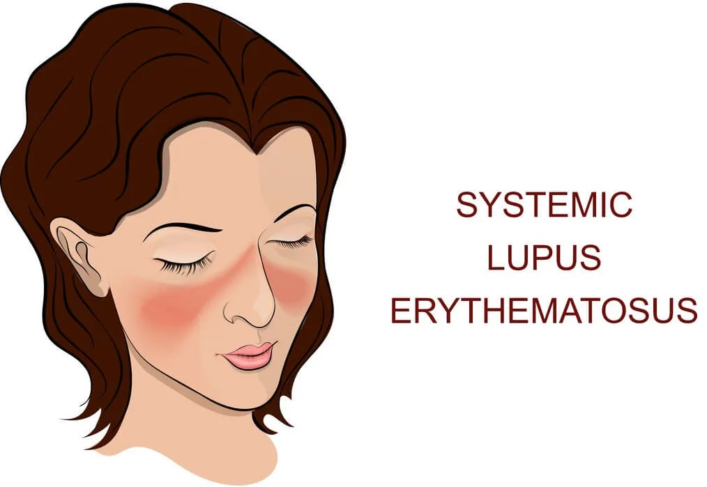 Stem Cell Therapy for Systemic Lupus Erythematosus